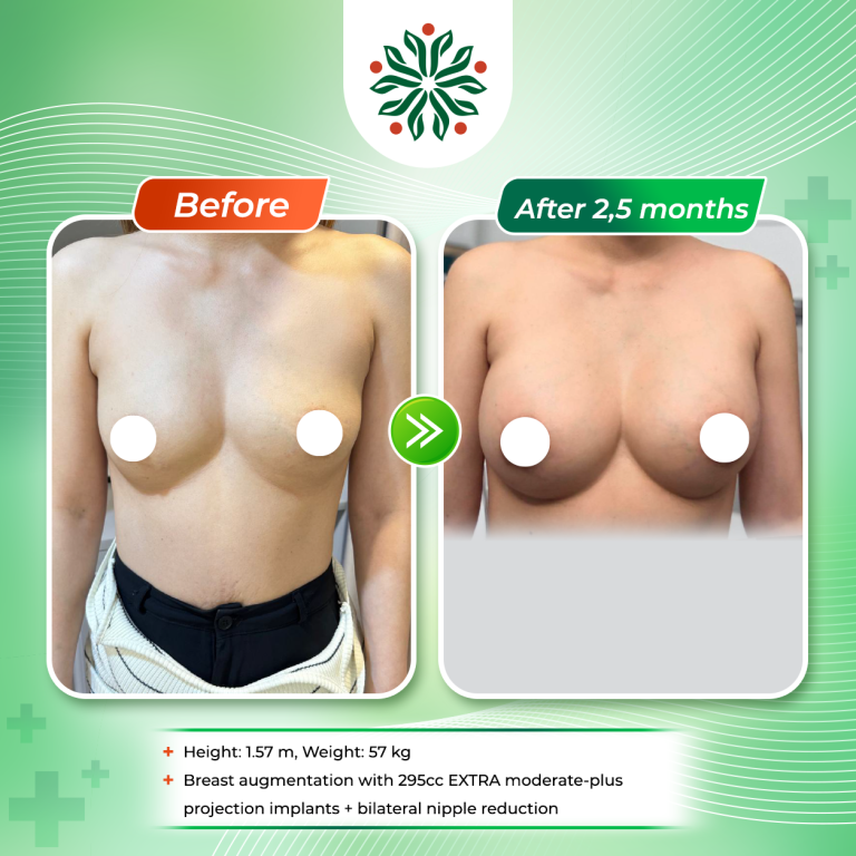 Mentor Extra 295 cc Implants with Moderate-High Projection for a Postpartum Woman with an Abnormal Chest Structure