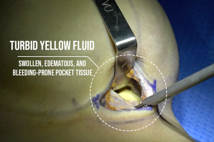 Turbid Yellow Fluid and Swollen, Edematous, Bleeding-Prone Pocket Tissue Found After 10 Years with Polytech Implants