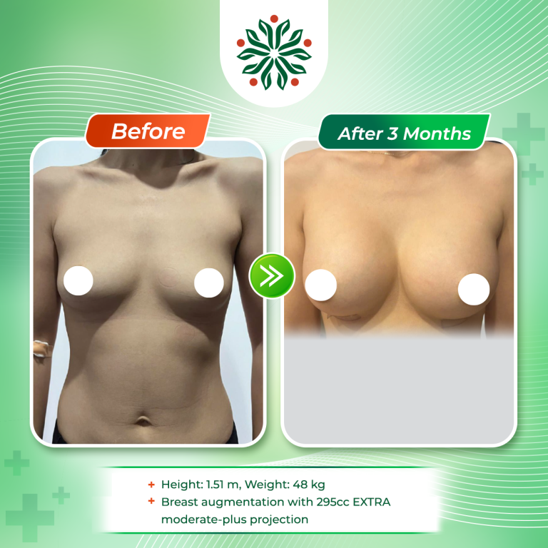 Mentor Extra 295cc Breast Augmentation for a Petite Patient with a Short Inframammary Fold and Postpartum Upper Pole Tissue Deficiency