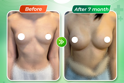 Breast Augmentation with Two Different Implant Sizes, 275 cc and 300 cc: A Solution for Patients with a Concave and Asymmetric Chest Wall