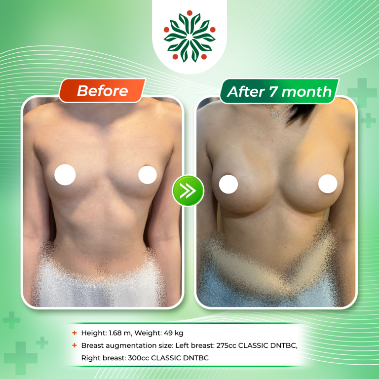 Breast Augmentation with Two Different Implant Sizes, 275 cc and 300 cc: A Solution for Patients with a Concave and Asymmetric Chest Wall