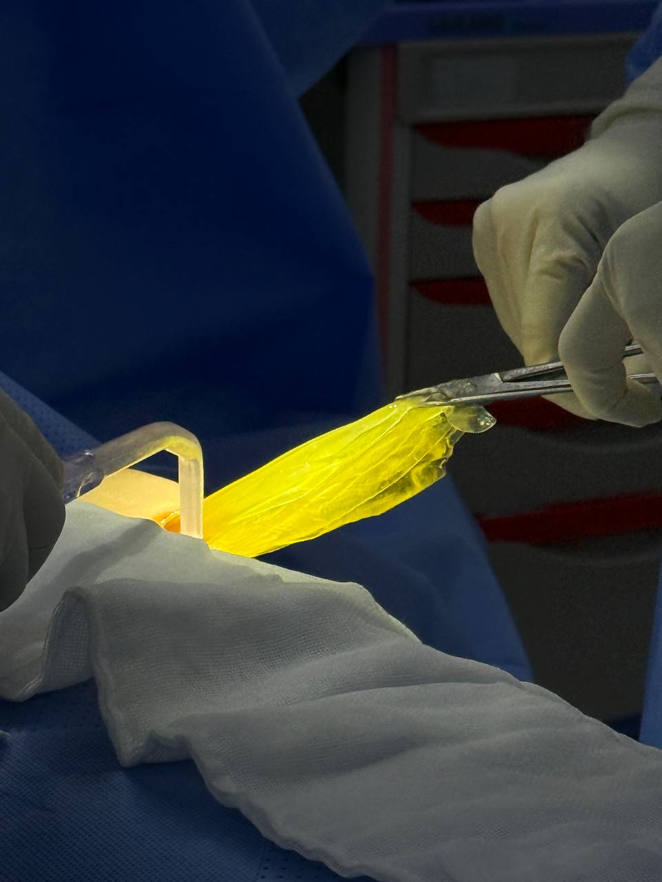 Causes of early breast implant rupture