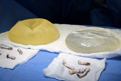 Differences between textured and smooth breast implants on the same body