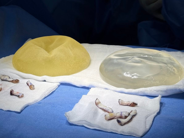 Differences between textured and smooth breast implants on the same body