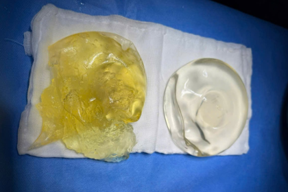 Silent Breast Implant Rupture: What Women Need to Know