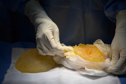 Breast Implant Screening for Silent Rupture: What the FDA Recommends