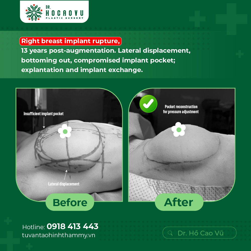 Breast Implant Removal in Vietnam: Cost & Safety Guide