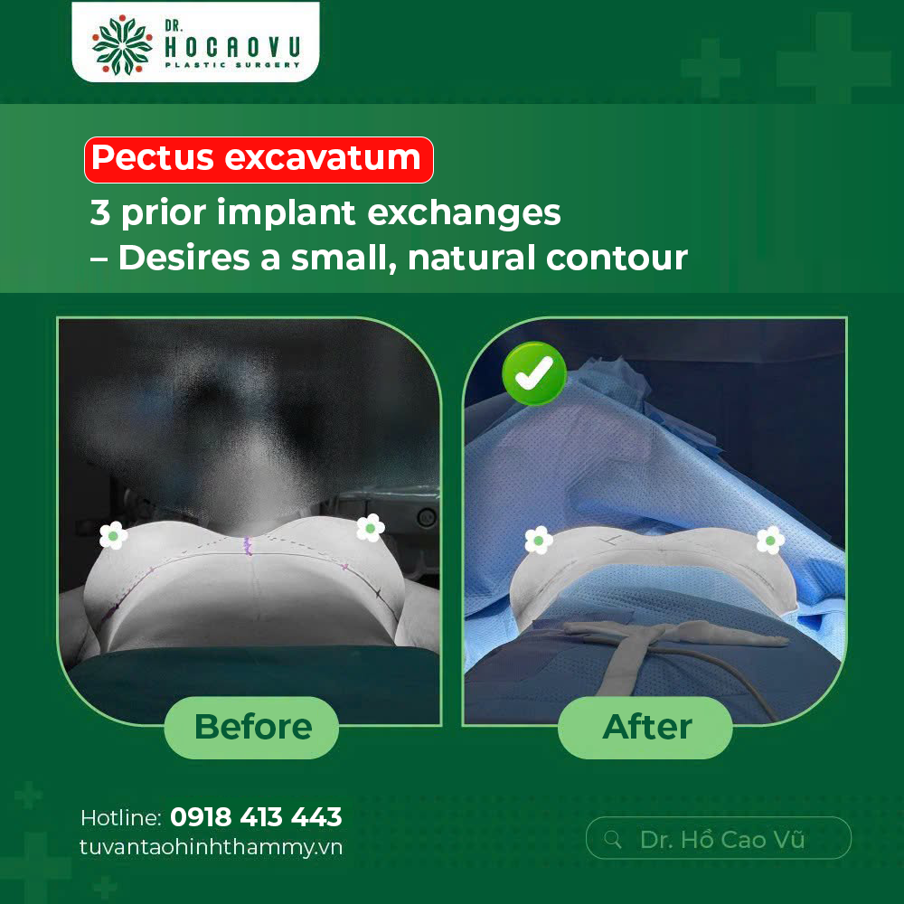 Breast Implant Removal (Explant Surgery): A Complete Guide