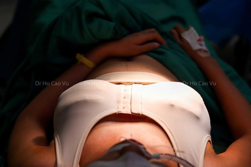 Breast Implant Removal (Explant Surgery): A Complete Guide