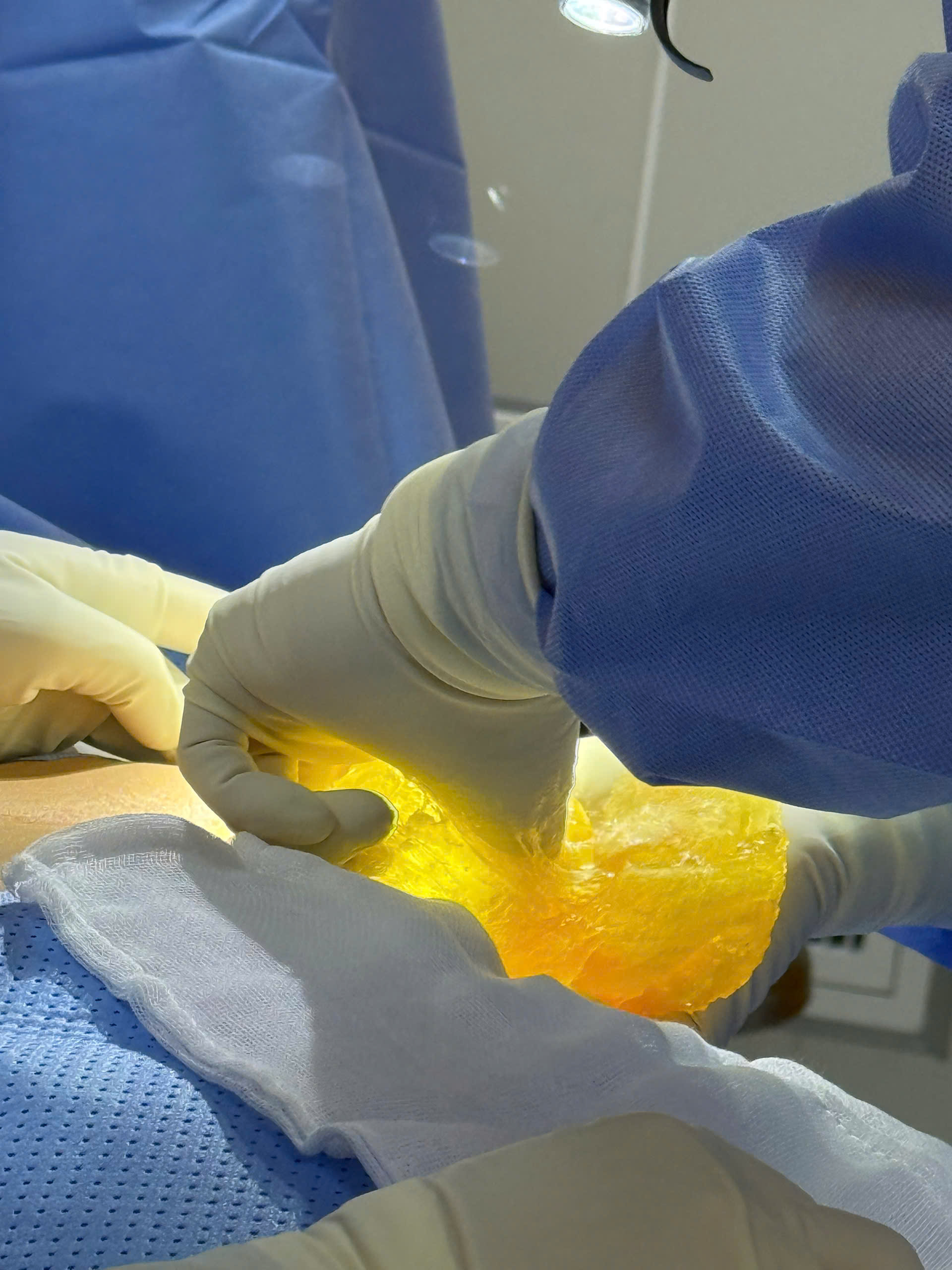 Breast Implant Screening for Silent Rupture: What the FDA Recommends