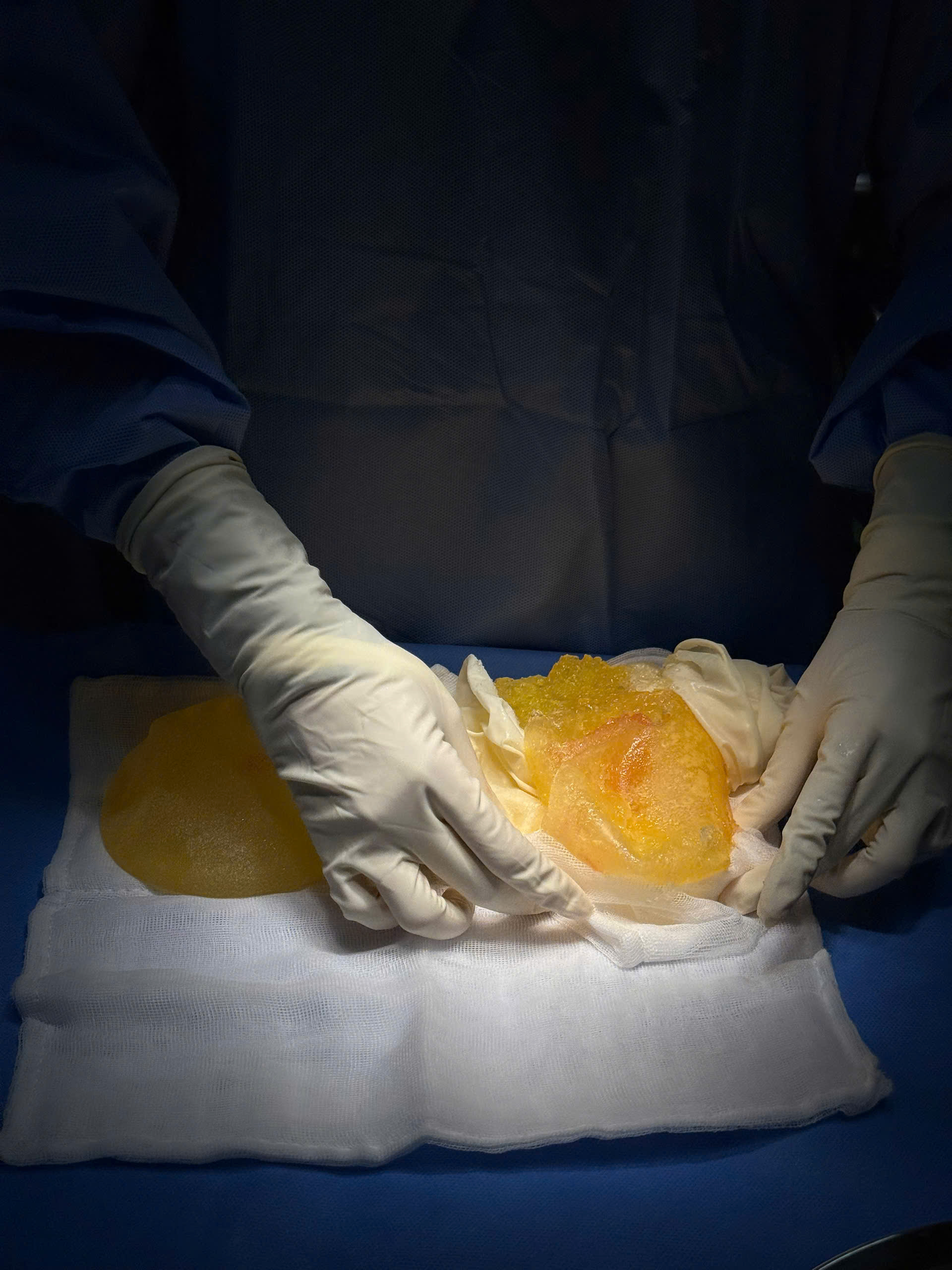 Breast Implant Screening for Silent Rupture: What the FDA Recommends