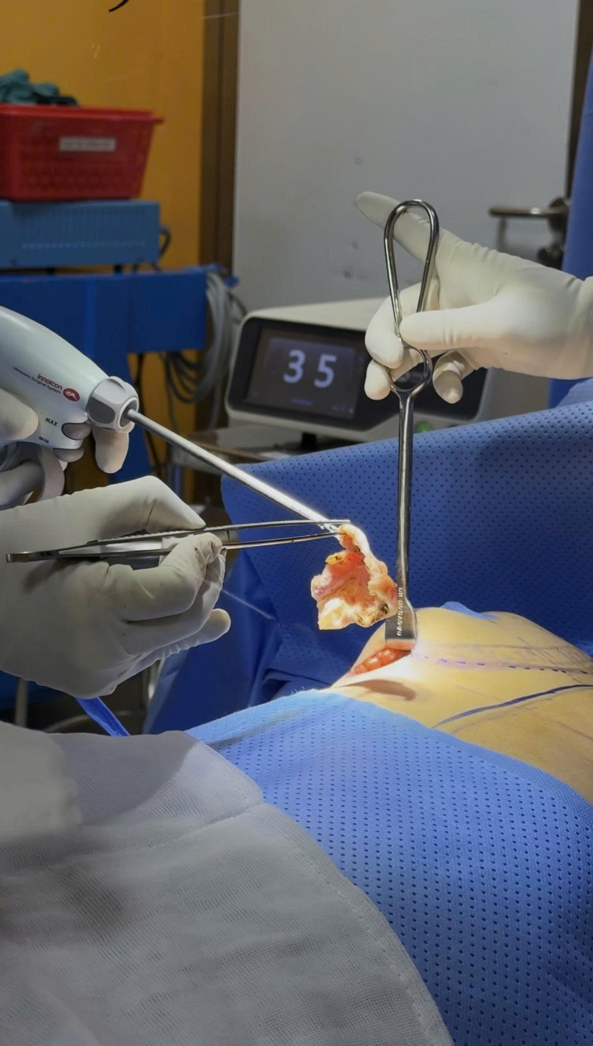 Capsular Contracture Treatment: Surgical and Non-Surgical Options Compared