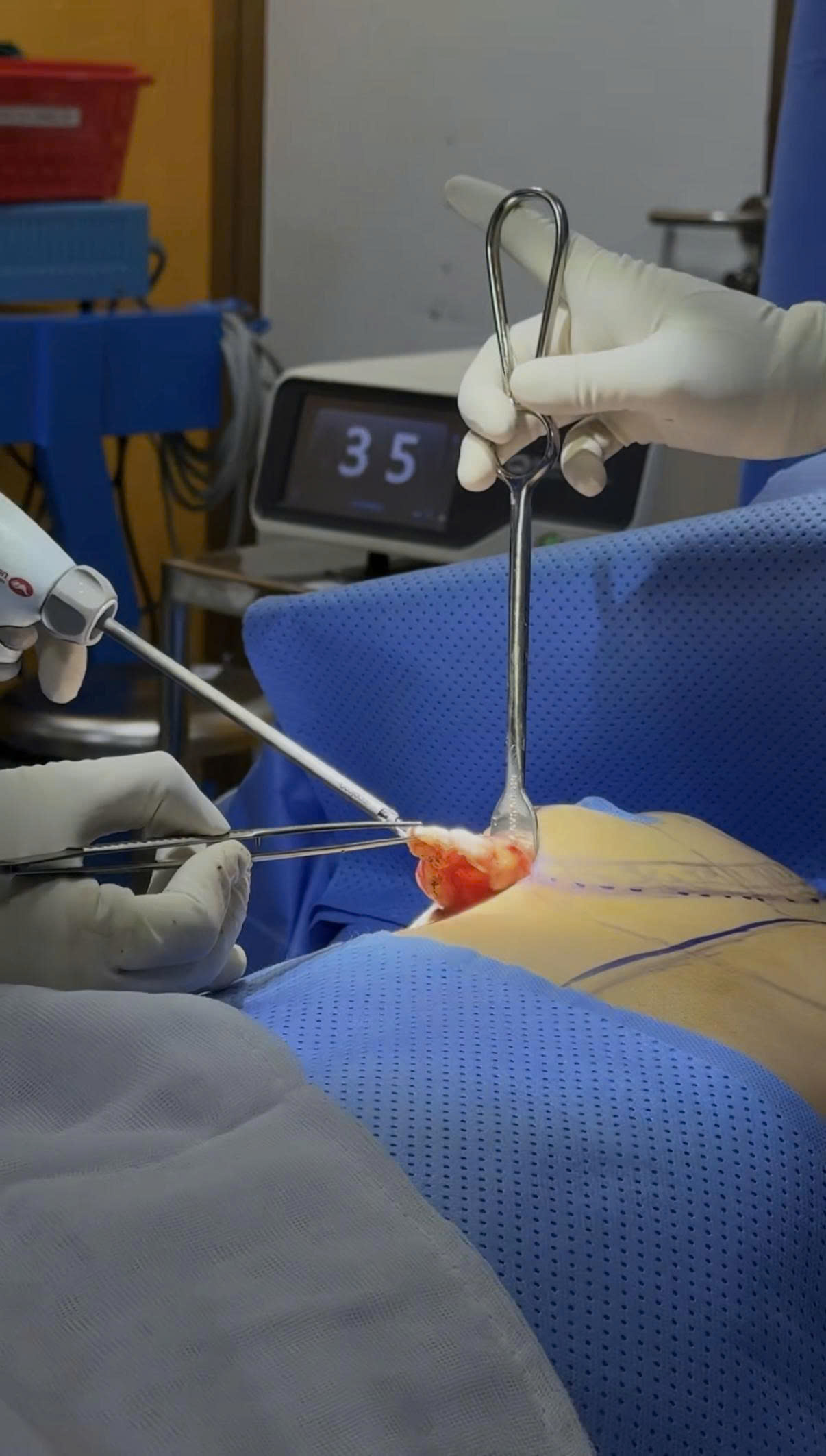 Capsular Contracture Treatment: Surgical and Non-Surgical Options Compared