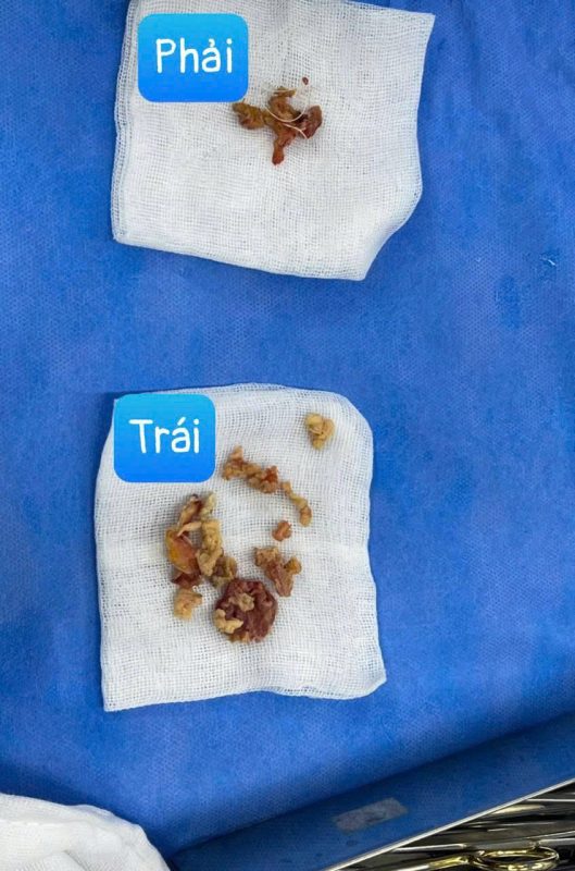 Silent Infection Found During a Third Breast Augmentation: What the Pocket Revealed