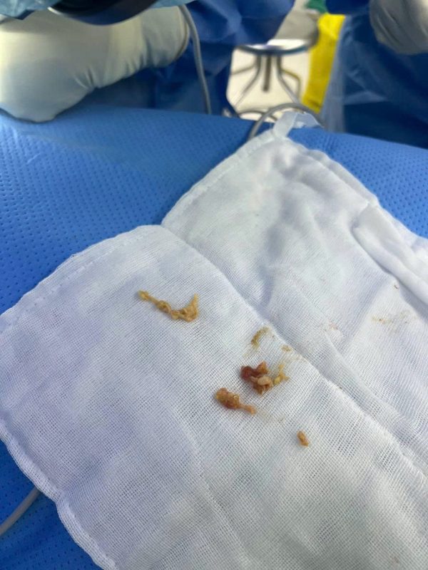 Silent Infection Found During a Third Breast Augmentation: What the Pocket Revealed