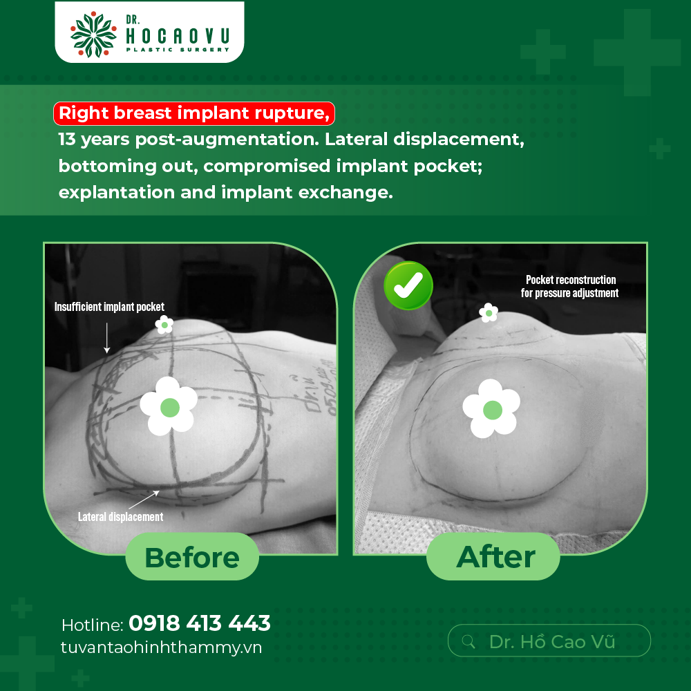 Breast Implant Removal in Vietnam: Cost & Safety Guide