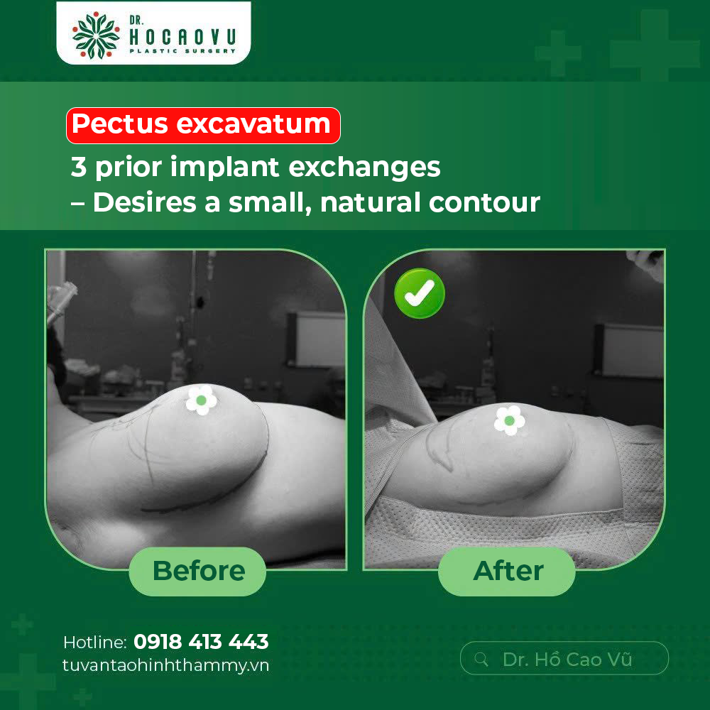 Breast Implant Removal (Explant Surgery): A Complete Guide