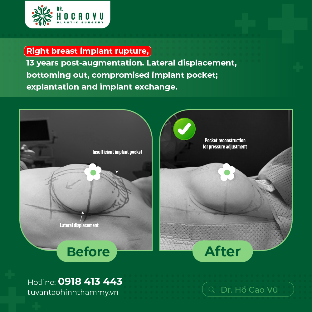 Breast Implant Removal in Vietnam: Cost & Safety Guide