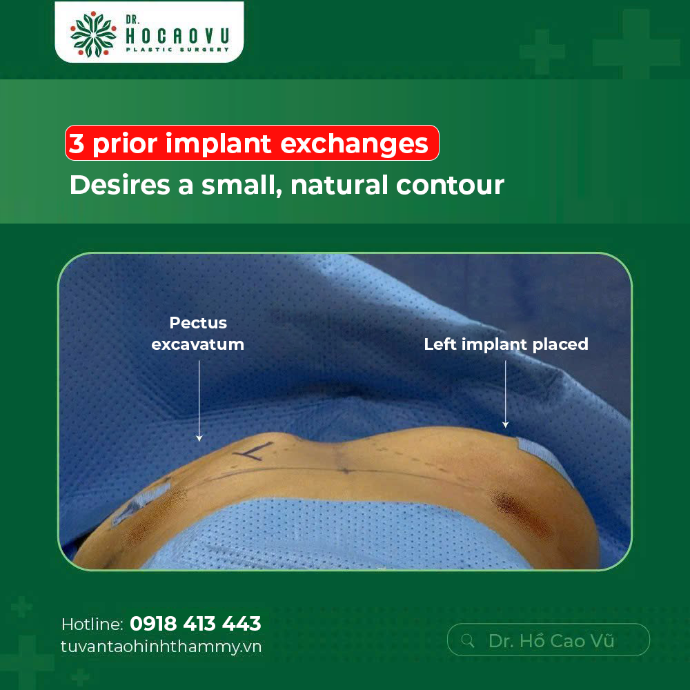Breast Implant Removal (Explant Surgery): A Complete Guide