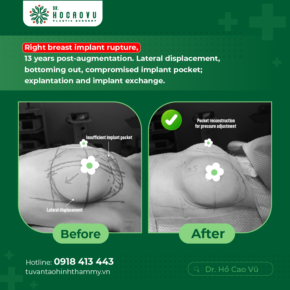 Breast Implant Removal in Vietnam: Cost & Safety Guide