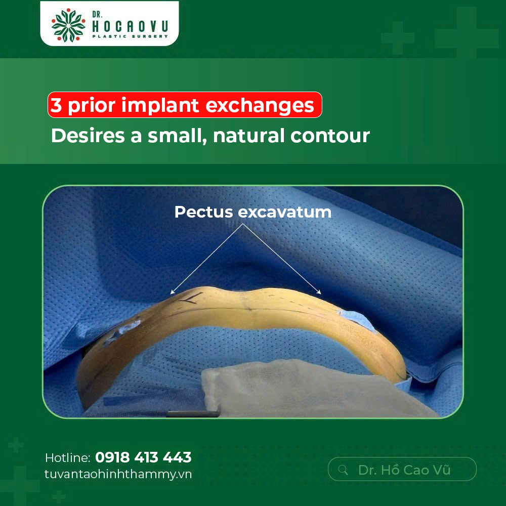 Breast Implant Removal (Explant Surgery): A Complete Guide