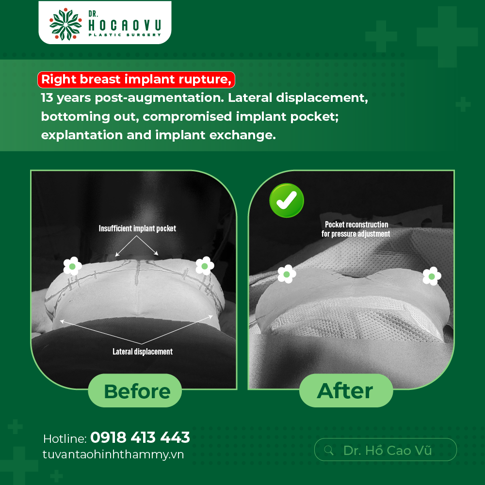 Breast Implant Removal in Vietnam: Cost & Safety Guide