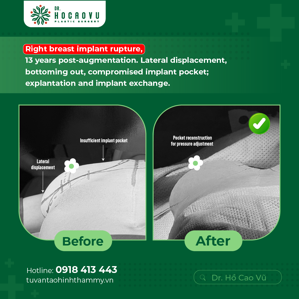 Breast Implant Removal in Vietnam: Cost & Safety Guide