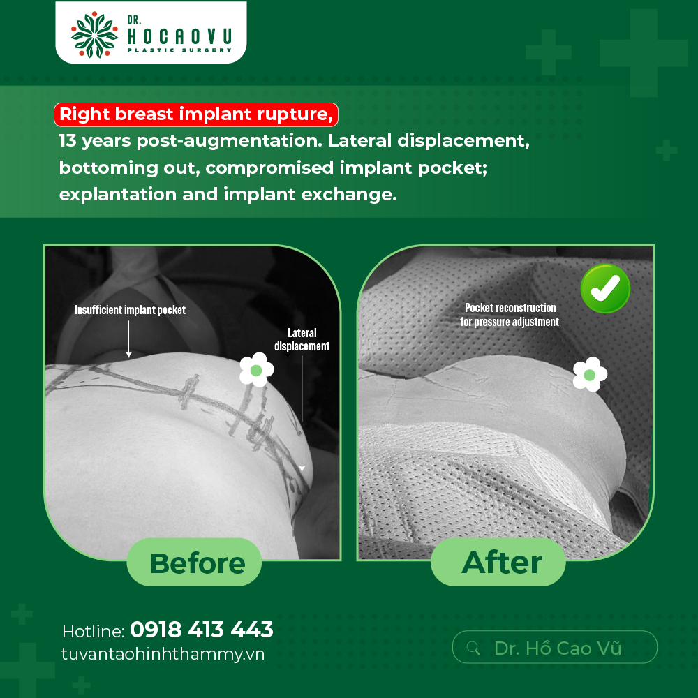 Breast Implant Removal in Vietnam: Cost & Safety Guide
