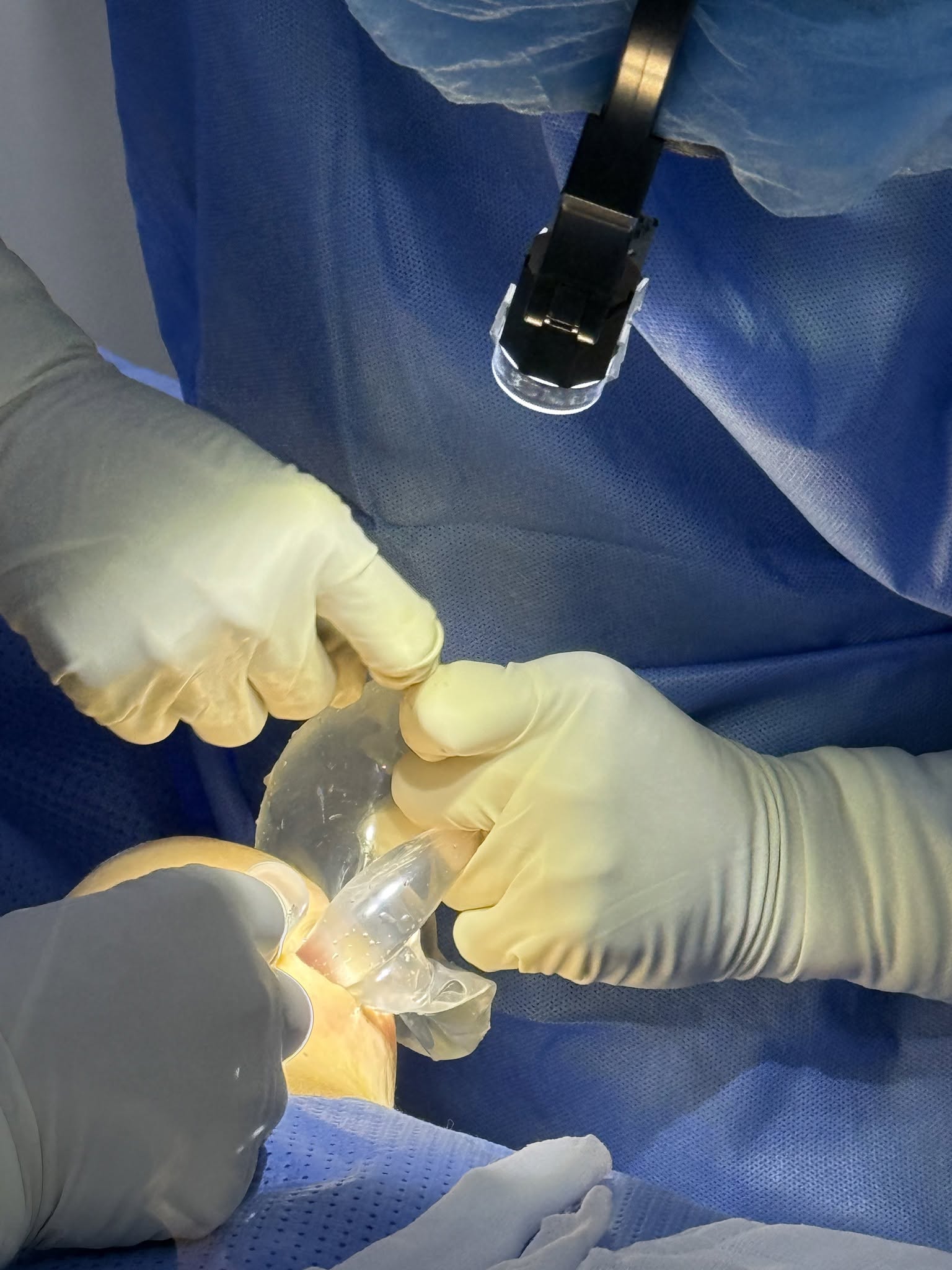 Breast Implant Removal in Vietnam: Cost & Safety Guide