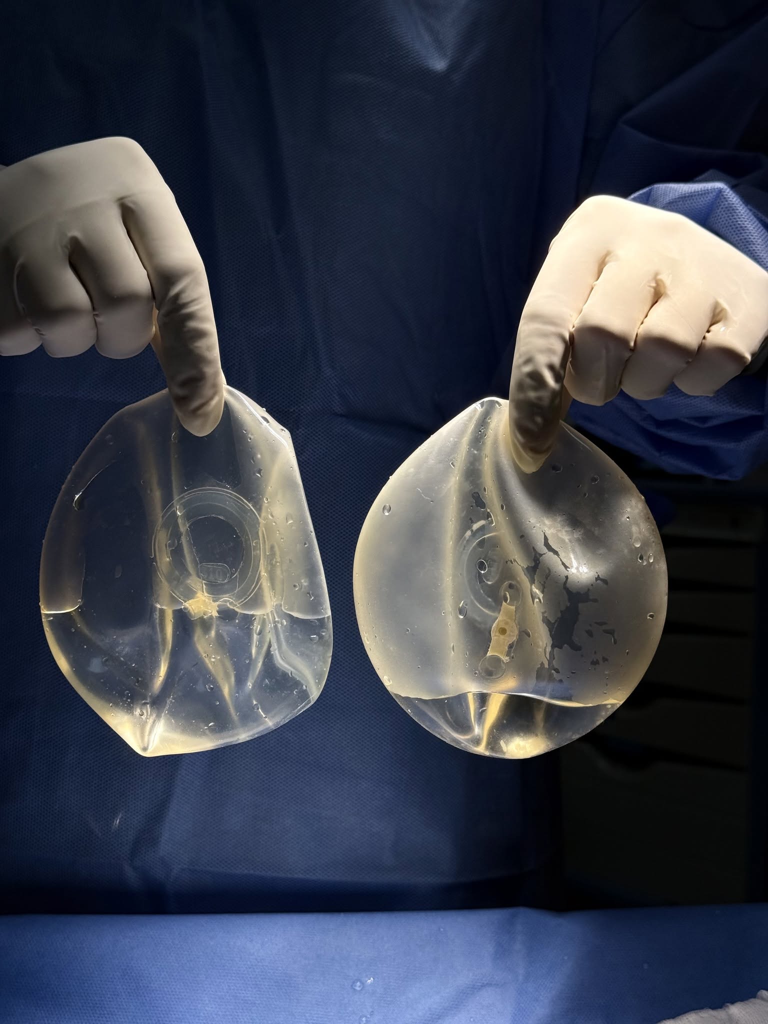 Breast Implant Removal in Vietnam: Cost & Safety Guide