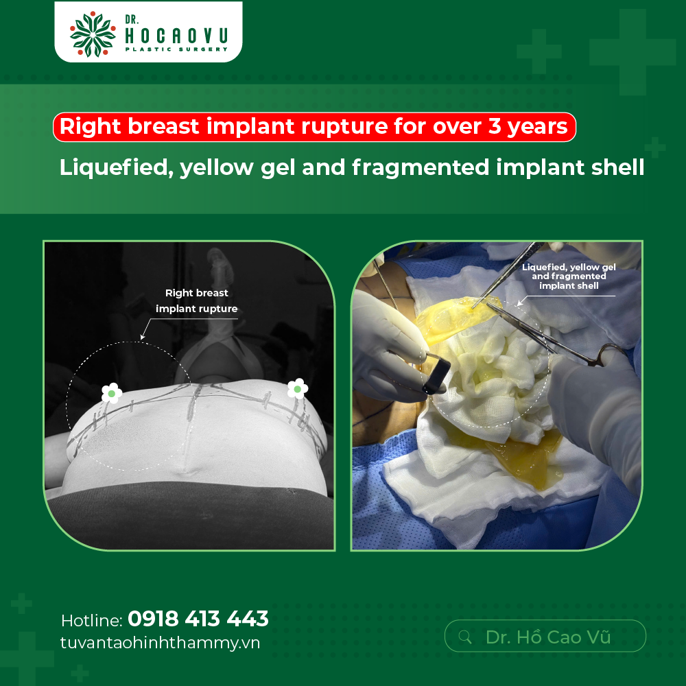 Breast Implant Removal in Vietnam: Cost & Safety Guide