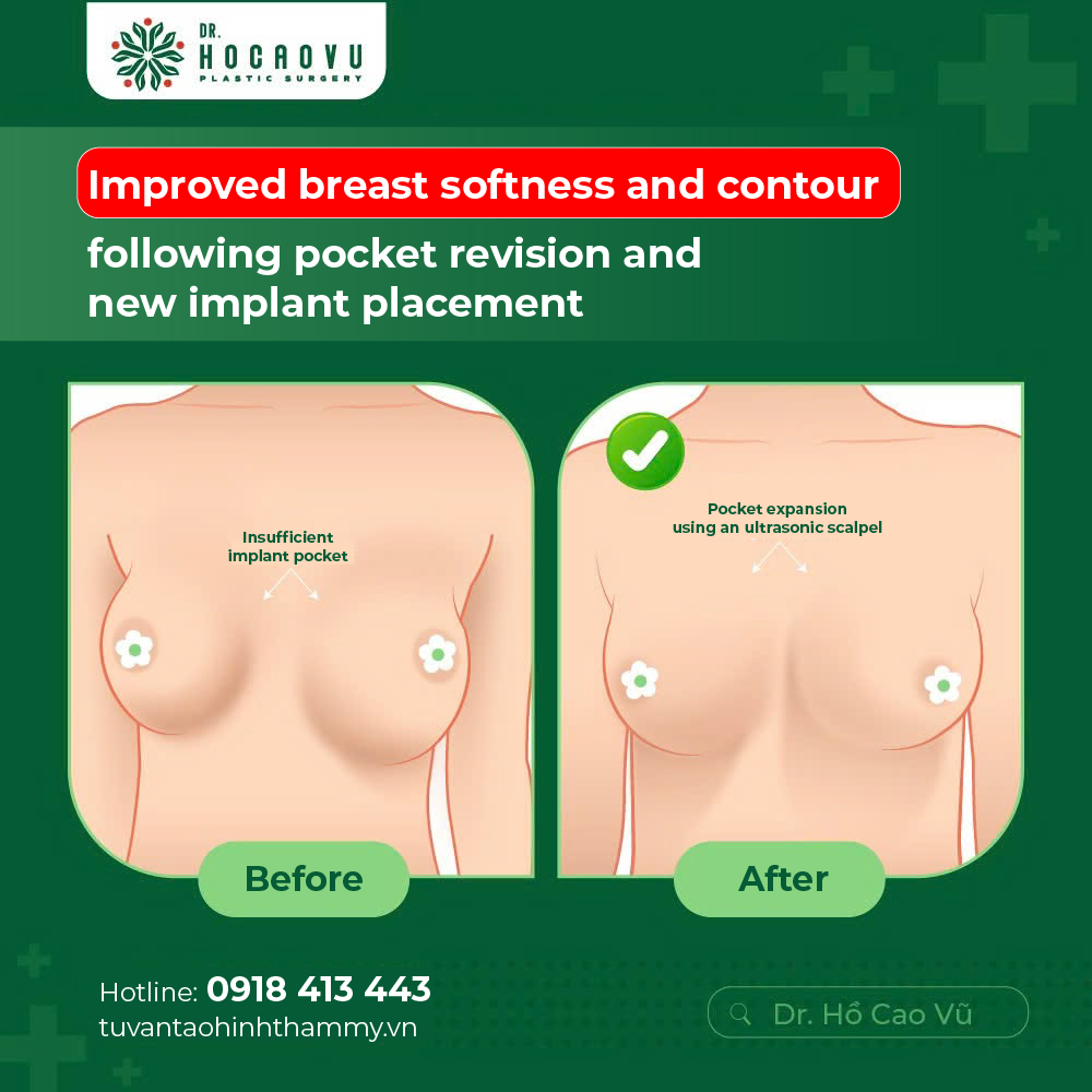 Capsular Contracture Treatment: Surgical and Non-Surgical Options Compared