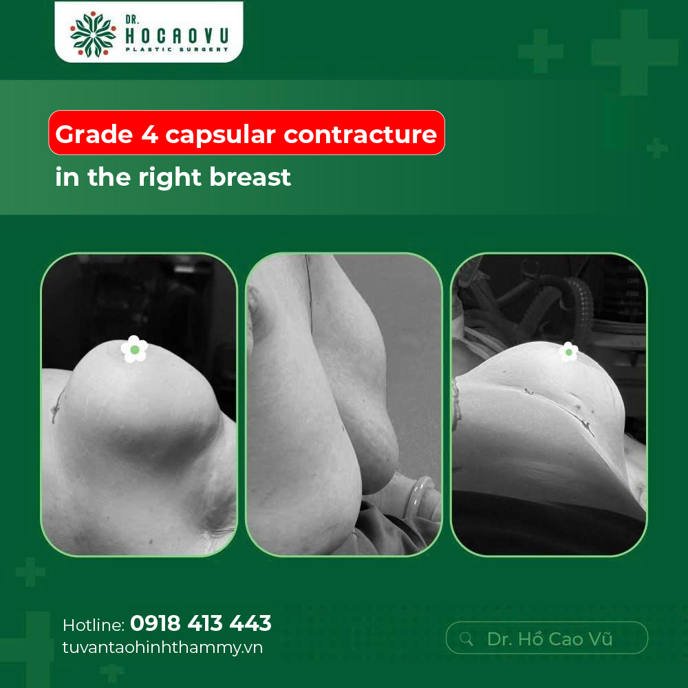 Capsular Contracture Treatment: Surgical and Non-Surgical Options Compared