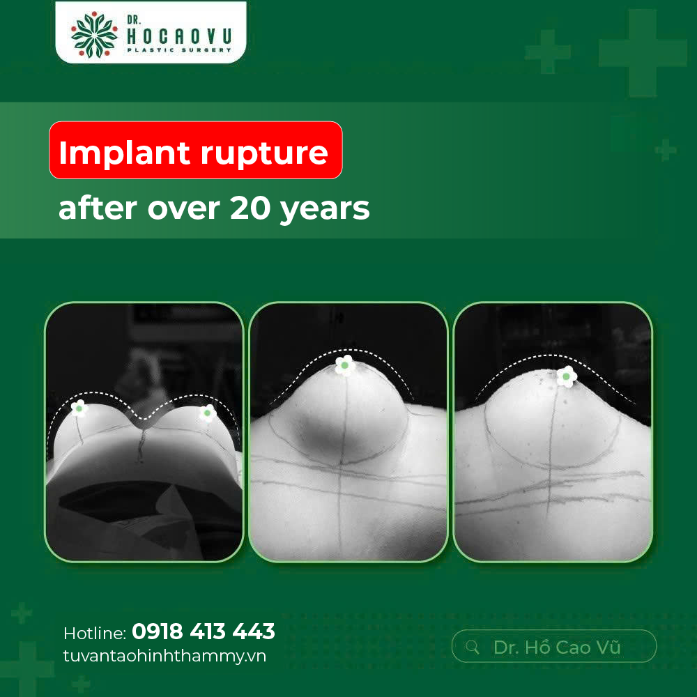 Capsular Contracture Treatment: Surgical and Non-Surgical Options Compared