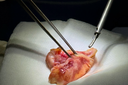 Capsular Contracture Treatment: Surgical and Non-Surgical Options Compared