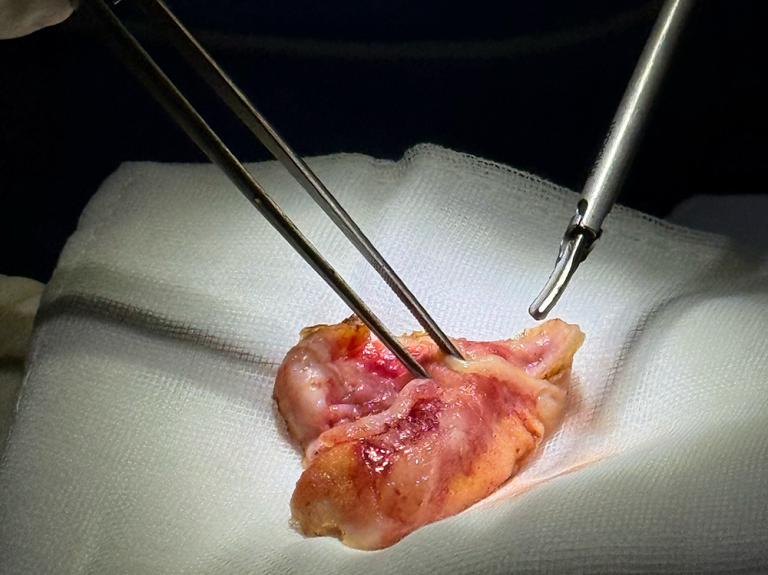 Capsular Contracture Treatment: Surgical and Non-Surgical Options Compared