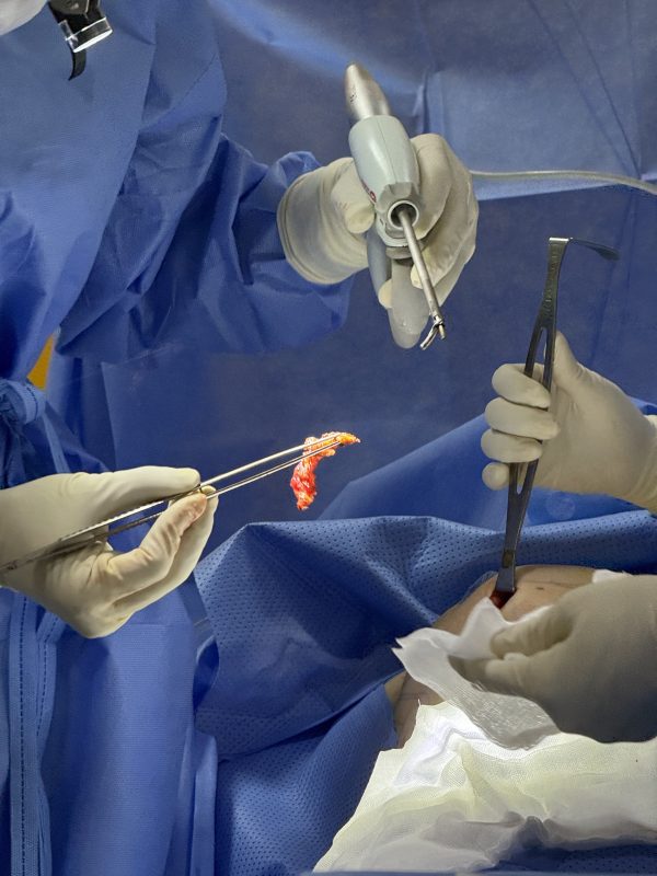 Removal of Polytech Textured Breast Implants After 11 Years - Relief from Grade IV Capsular Contracture