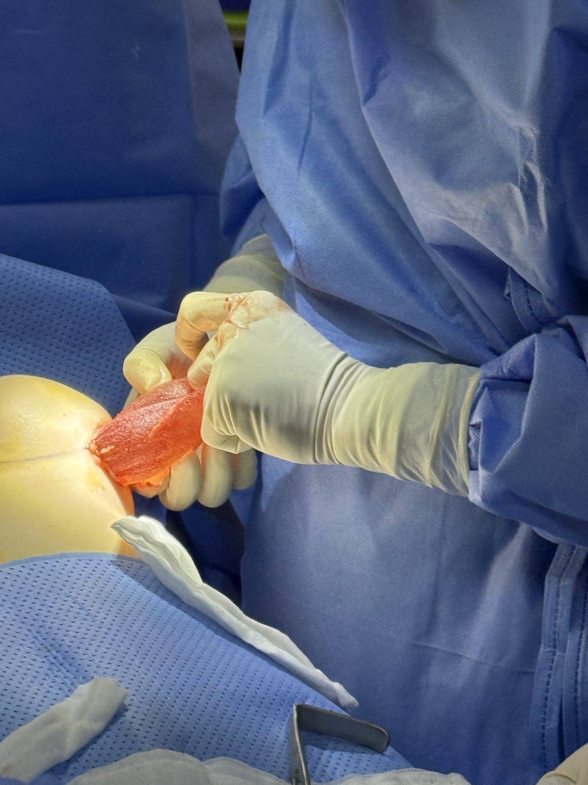 Removal of Polytech Textured Breast Implants After 11 Years - Relief from Grade IV Capsular Contracture