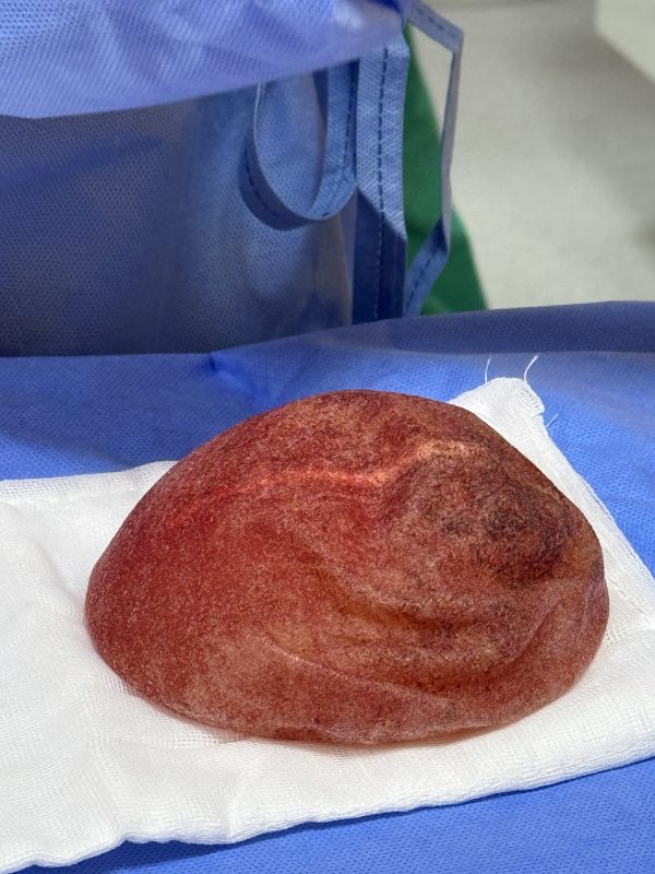 Removal of Polytech Textured Breast Implants After 11 Years - Relief from Grade IV Capsular Contracture