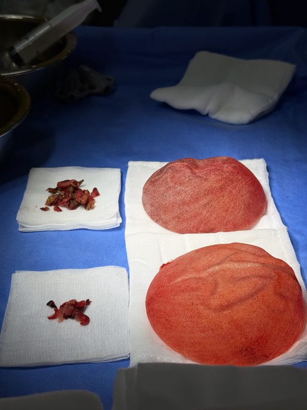 Removal of Polytech Textured Breast Implants After 11 Years - Relief from Grade IV Capsular Contracture