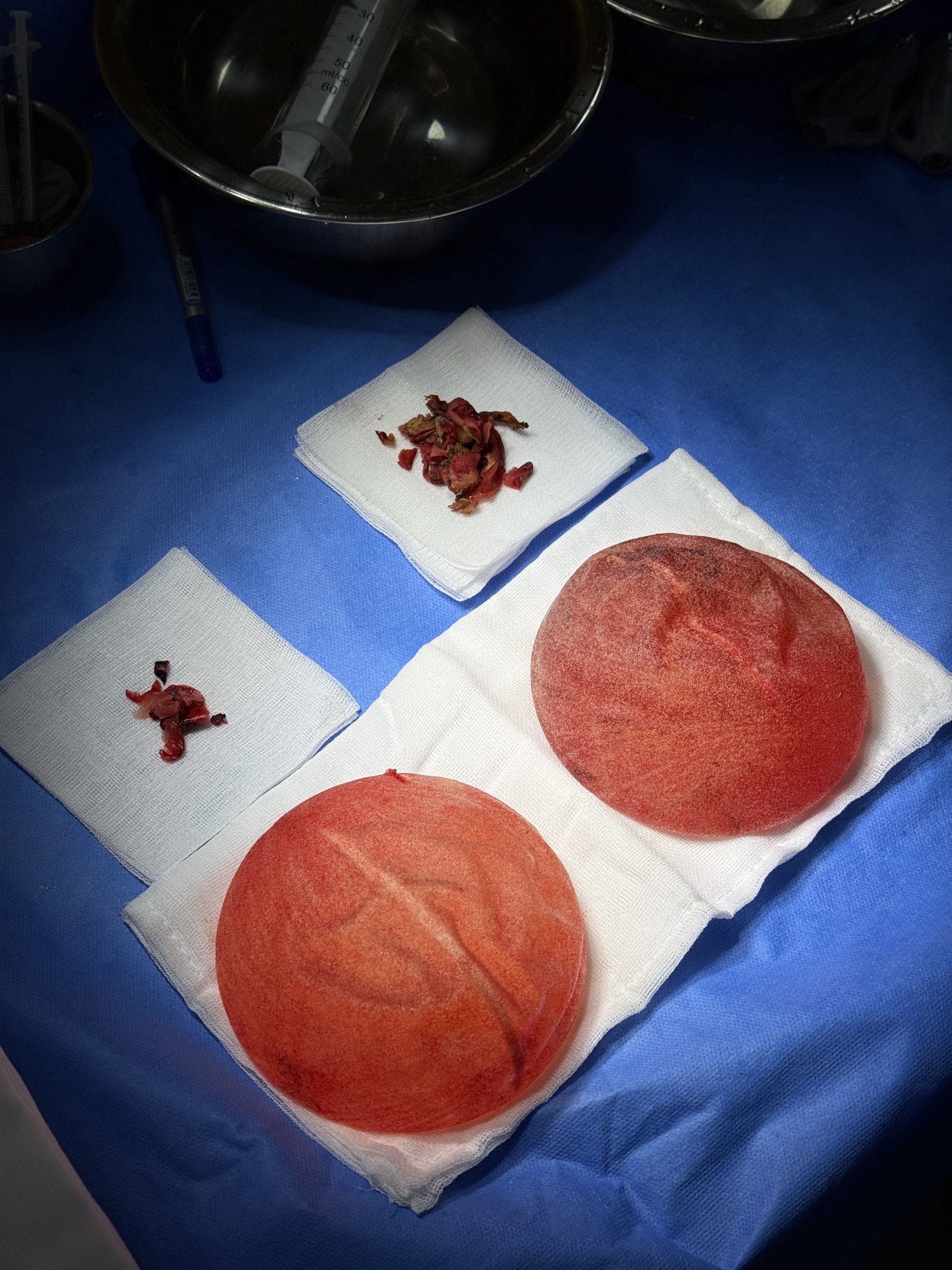 Removal of Polytech Textured Breast Implants After 11 Years - Relief from Grade IV Capsular Contracture