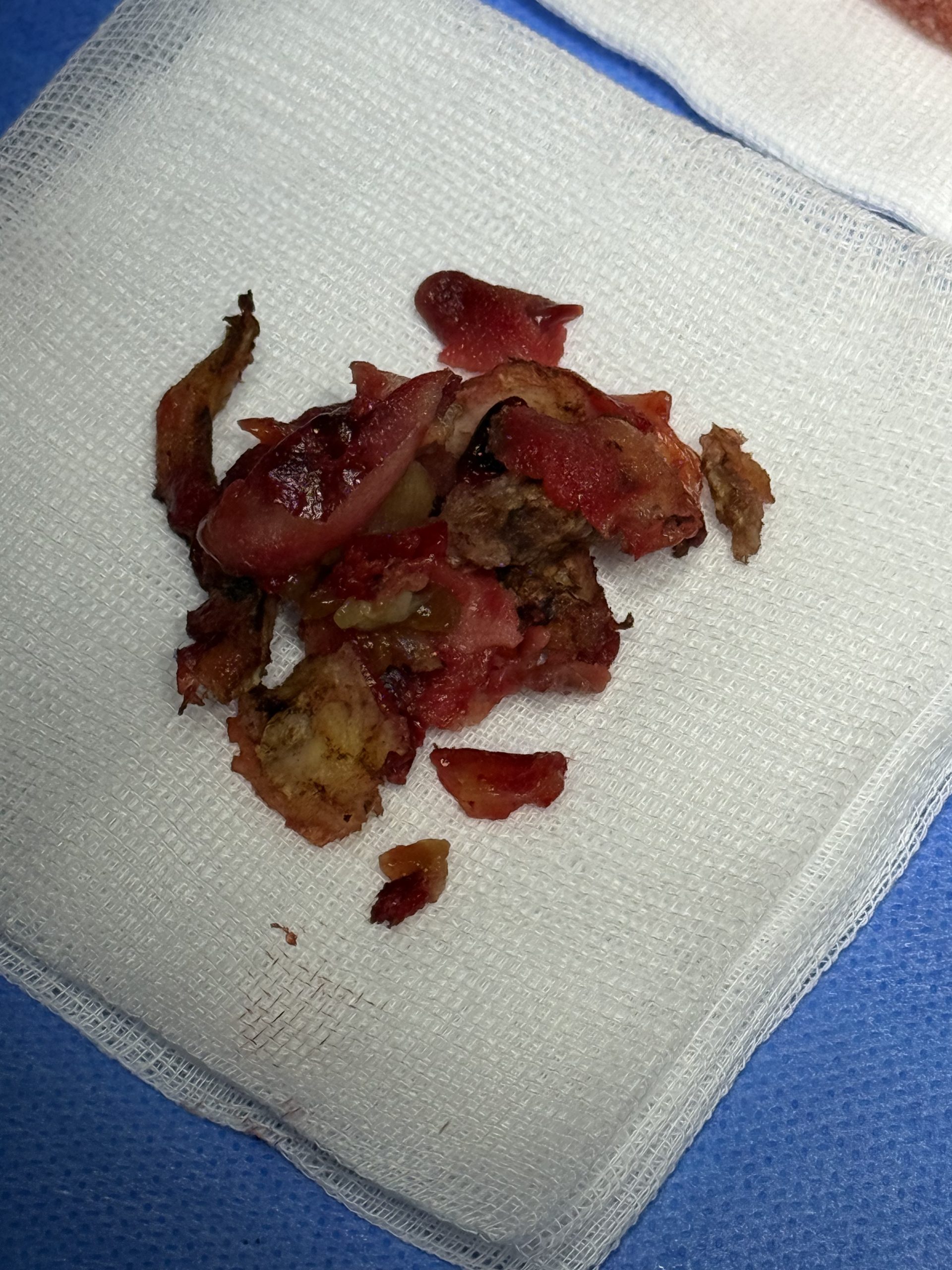 Removal of Polytech Textured Breast Implants After 11 Years - Relief from Grade IV Capsular Contracture