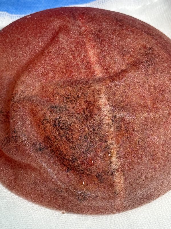 Removal of Polytech Textured Breast Implants After 11 Years - Relief from Grade IV Capsular Contracture