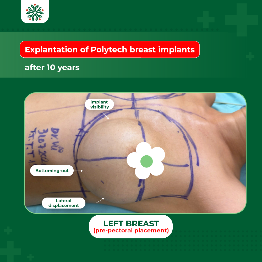 Comparing Complications: Subglandular Placement Leading to Implant Visibility vs. Dual-Plane Resulting in Bottoming-Out and Implant Malposition