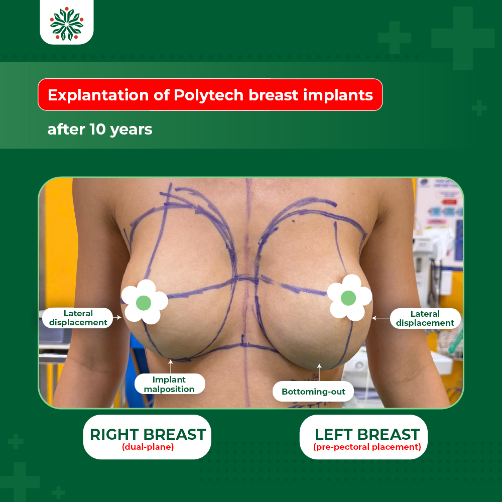 Comparing Complications: Subglandular Placement Leading to Implant Visibility vs. Dual-Plane Resulting in Bottoming-Out and Implant Malposition