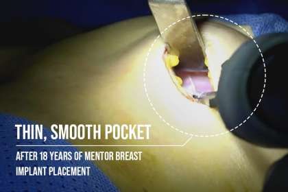 Thin, smooth pocket after 18 years of Mentor breast implant placement