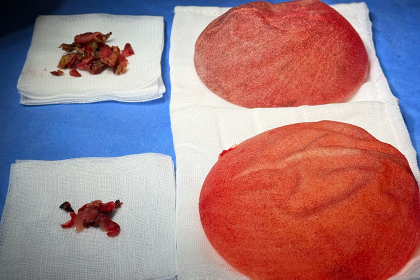 Removal of Polytech Textured Breast Implants After 11 Years – Relief from Grade IV Capsular Contracture