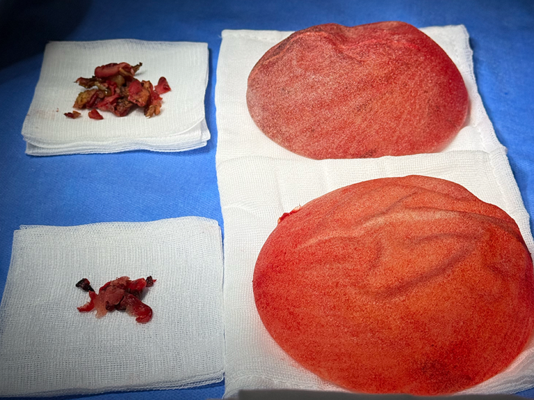 Removal of Polytech Textured Breast Implants After 11 Years - Relief from Grade IV Capsular Contracture