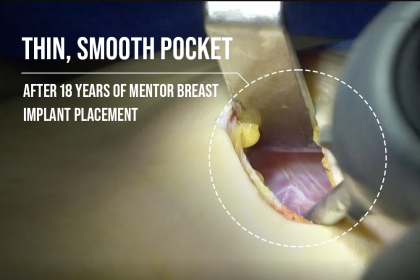 Thin, smooth pocket after 18 years of Mentor breast implant placement
