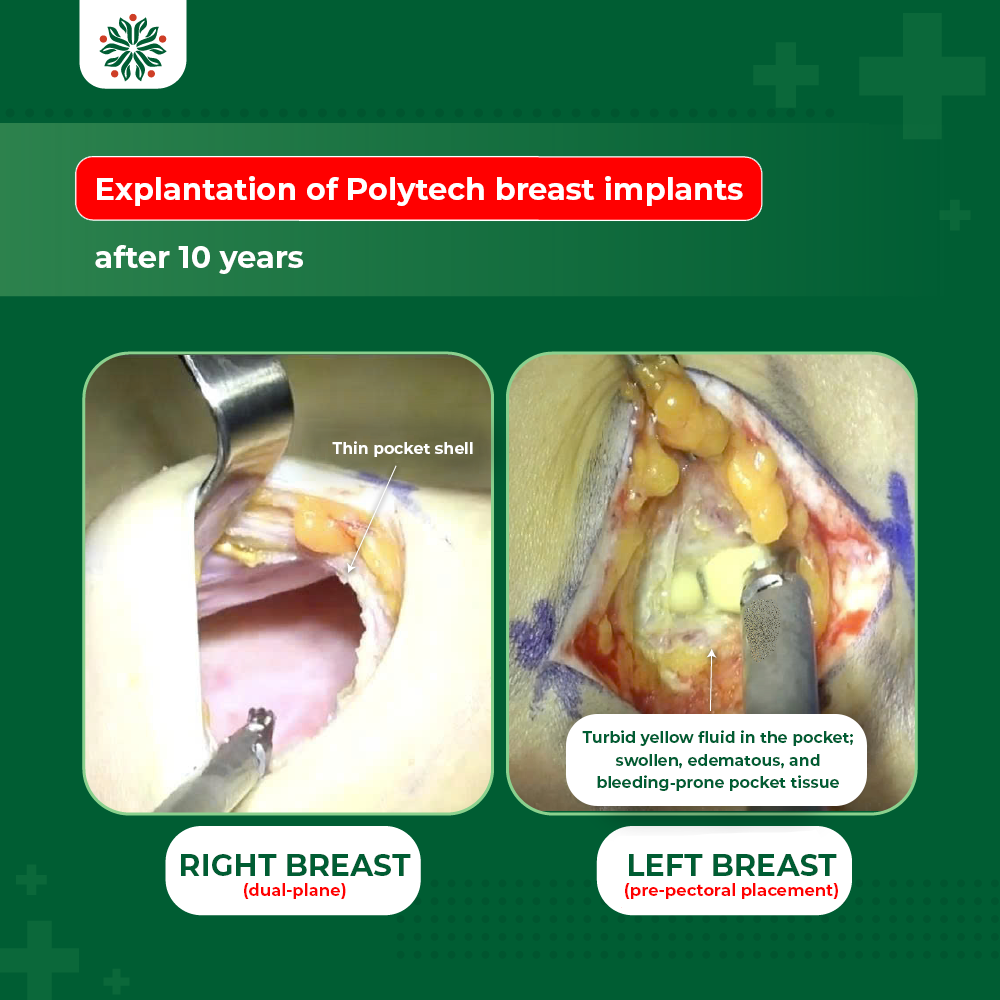 Comparing Complications: Subglandular Placement Leading to Implant Visibility vs. Dual-Plane Resulting in Bottoming-Out and Implant Malposition